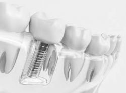 Dental Implant Specialist Near Me | Top-Rated Dental Implants