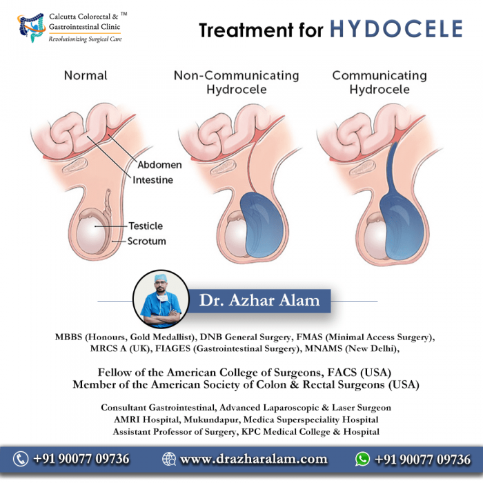Hydrocele Doctor in Kolkata | Best Treatment for Hydrocele