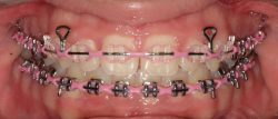 Choose the Best Colors for your Braces |Ivanov Orthodontic