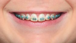 How to Choose the Best Braces Colors? |Ivanov Orthodontic