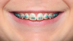 How to Choose the Best Braces Colors? |Ivanov Orthodontic