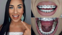 What Are The Best Braces Colors? | How to Pick the Best Colors for Your Braces