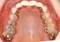 How Much Does Metal Braces Cost? | How much will it cost for Metal Braces