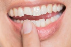 Deep Teeth Cleaning Near Me | Teeth Cleaning Before And After | deep teeth cleaning