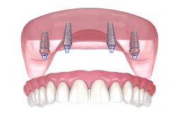 Dental Implant Manhattan NYC