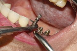 Chronic Dental Abscess Complications | nearestemergencydentist