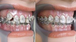 Clear Teeth Aligners In Houston, Tx | Clear Aligners Service In Houston