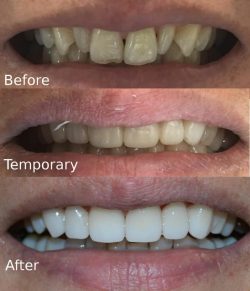  Dental Veneers Cost – Edge Dental Houston