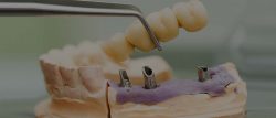 Dental Implants Dentist in Houston TX