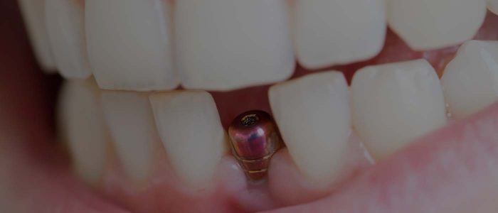 Top Dental Implant Dentist in Houston TX