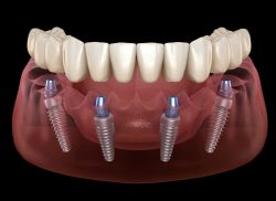 Implant Dentist in Houston TX | Implant dentistry near me