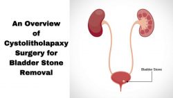 An Overview of Cystolitholapaxy Surgery for Bladder Stone Removal