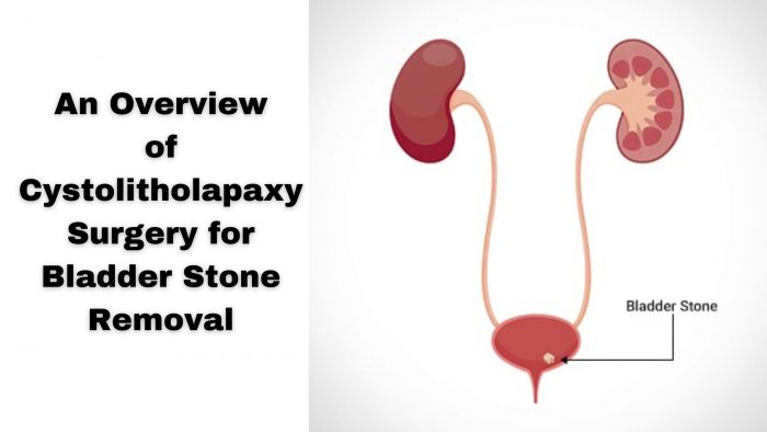 An Overview of Cystolitholapaxy Surgery for Bladder Stone Removal