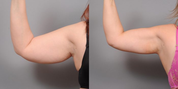 Arm Lipo Before and After | premieresurgicalarts