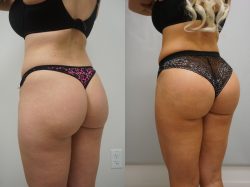 Before and After Pictures of Brazilian Butt Lift | premieresurgicalarts
