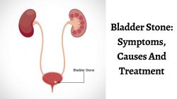 Bladder Stone: Symptoms, Causes And Treatment