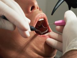 What’s The Reason For Temporary Filling On Tooth And Not Permanent? | What is Temporary To ...