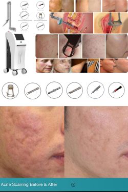Evaluation of CO2 fractional laser beauty machine treatment effect