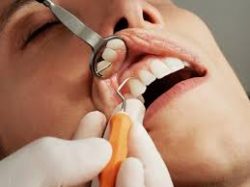 Deep Teeth Cleaning Near Me | Teeth Cleaning Before And After | teeth deep cleaning