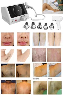 What are the specific steps of laser hair removal treatment