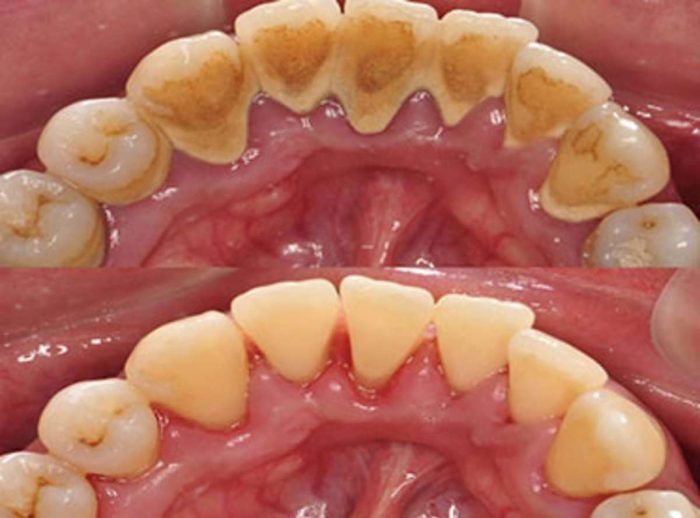 Gum Disease Treatment Near Me | Gum Diseases – Non Surgical Treatment, Gum Surgery