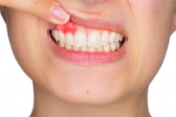Gum Disease Treatment Near Me | laserdentistrynearme