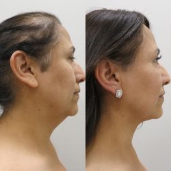 How Much Does a Neck Liposuction cost? | Cost of Double Chin Liposuction Surgery