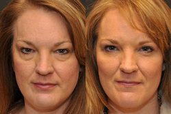 How Much Does Eye Lift Surgery Cost? | Price is Right: How Much Does Eyelid Surgery Cost?