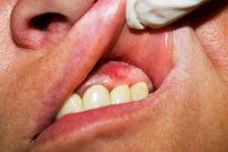 Gum Abscess: Pictures, Treatment, Symptoms, Causes