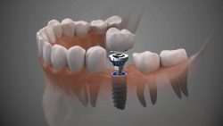Cosmetic Dental Implants in Houston TX | Best Cosmetic Dentistry In Houston