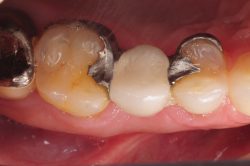 Signs & Symptoms of Tooth Abscess | dental checkups every six months