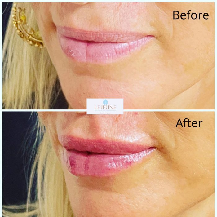 Get Rid Of Face Wrinkles And Skin Folds With Dermal Filler Treatment
