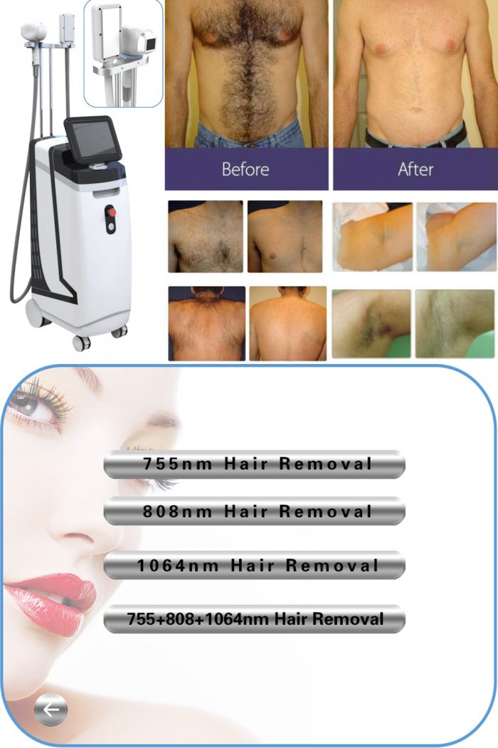 Criteria for choosing a permanent laser hair removal machine