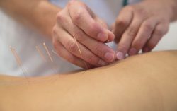 Acupuncture – Hitchin