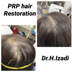 PRP Hair Loss Treatment San Ramon