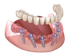 Same Day Dentures Near Me | Implant Retained Dentures Houston | Implant Supported Dentures Near  ...