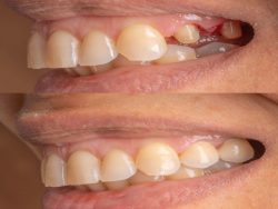 Cracked Teeth & Fractured Cusp Molar Treatment | nearestemergencydentist