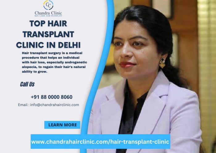 Top Hair Transplant Clinic in Delhi – Chandra Clinic