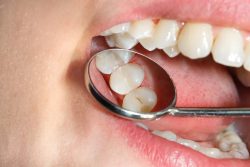What are the advantage of Composite Fillings?