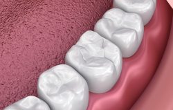 Damaged Teeth Treatment Options | nearestemergencydentist