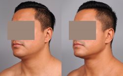 Double Chin/Neck Fat Removal