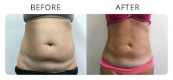 Before And After Liposuction Surgery