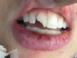 Fix Chipped & Broken Tooth Filling