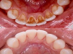 Porcelain Veneers Before And After | dentistveneershouston