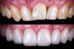 Dental Veneer Before And After | dentistveneershouston