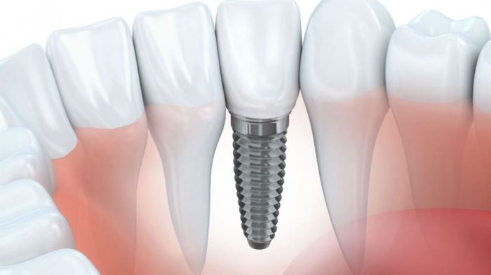 What is dental veneers cost in Houston? | dentistveneershouston