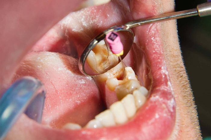 Dental Veneer Before And After | URBN Dental provides