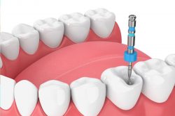What is dental veneers cost in Houston? | URBN Dental provides