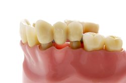 Dental Bridge Cost | Dental Bridge Treatment