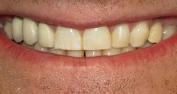 Dental Crown Procedure Cost
